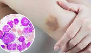 Evolución de la leucemia ya está escrita desde el inicio de la enfermedad