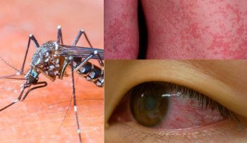 11.700 contagiados del virus zika en Colombia