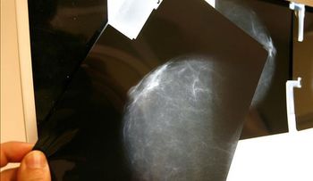 14,9 millones de casos nuevos de cáncer hubo en el mundo en el  2013