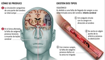 Accidente cerebrovascular isquémico