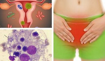 Con esto SI puede eliminar hongos vaginales, bacterias y mal olor, pero el ginecólogo nunca te lo dirá