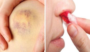 Señales de un cáncer en la sangre (Leucemia), que no debes ignorar 
