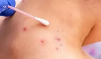 Haití emite alerta por presencia de viruela del mono en territorio dominicano