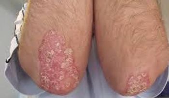 La psoriasis afecta la calidad de vida de quienes la padecen