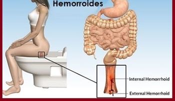 Las hemorroides son muy frecuentes y se tratan de las vénulas arteriolas del conducto anal