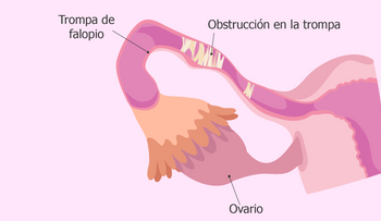  Un estudio ofrece pruebas que el colesterol puede afectar la esterilidad femenina 