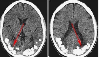 Descubren joven de 24 años, tenía piedras en el cerebro por más de 10 años; sufría de fuertes dolores de cabeza