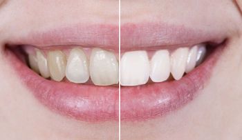 Ocho alimentos que dañan los dientes