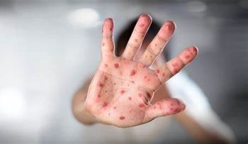 La viruela del mono se produce por contacto con animales; comienza con fiebre, dolor de cabeza y agotamiento