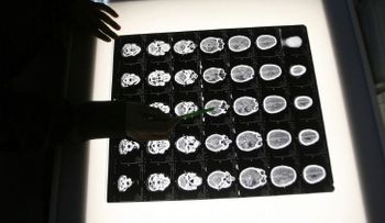 Un modelo matemático predice el desarrollo de los tumores cancerosos