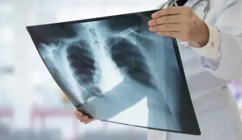 Las muertes globales por tuberculosis subieron por primera vez en una década