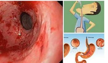 Elimina la acidez y la gastritis para SIEMPRE