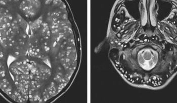 La impactante historia del paciente cuyo cerebro estaba lleno de parásitos