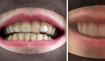 Estudiante diseña sus propios aparatos dentales por 60$ y se ahorra 8000$