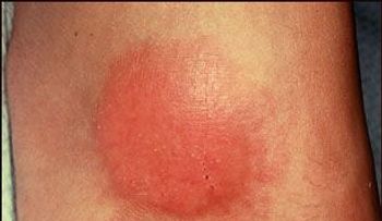 Granuloma anular, causas y síntomas