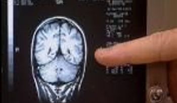 Avance argentino para detección precoz del Parkinson.