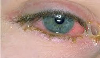 Más de 66 mil casos de conjuntivitis se han registrado en RD en lo que va de año