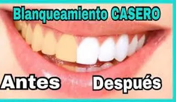Blanquea tus dientes en 15 min con esta receta que un dentista jamás te dirá. Antes y después