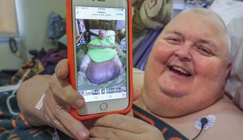 "Estoy ansioso por comer tacos"; dice hombre que le sacaron un tumor de 59 kilos que nació de un vello encarnado
