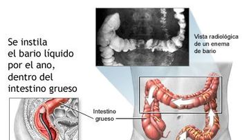 Pólipos colorrectales; causas y síntomas