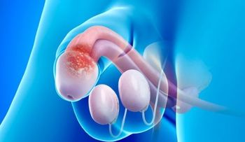Cáncer de pene y su tratamiento (VIDEO)