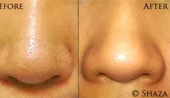 Elimina los puntos negros en menos de 10 minutos y solo necesitarás: 