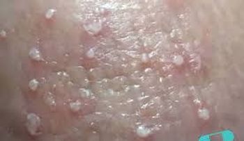 ¡Impactante revelación: La candidiasis es una enfermedad causada por el estrés y pasar mucho tiempo sentada
