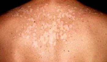 Los hongos de tu cuerpo no serán NUNCA más problema con este poderoso tónico casero