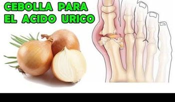 Esto no tiene desperdicio; elimina el ácido úrico con solo 2 cebollas: así es cómo se hace: