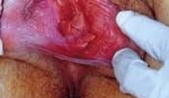 Curas para vestibulitis vulvar