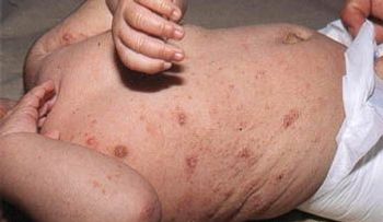 La sarna o escabiosis: enfermedad que puede contagiar a hombres y mujeres; descubre cómo se trata