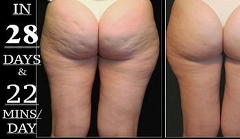 El uso correcto del vinagre de sidra de manzana para eliminar la celulitis en la noche â?¦