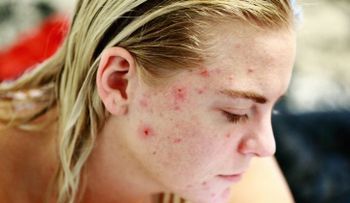 ¿Cómo tratar los problemas cutáneos derivados de la hepatitis?; causan 1,34 millones de muertes cada año