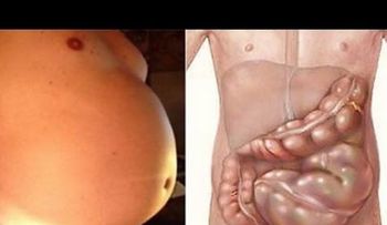 Tenía la panza grandísima por un estreñimiento por la comida chatarra, tomé vinagre con miel y en 7 días el problema desapareció 