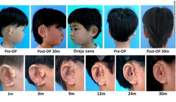Científicos crean oídos nuevos para niños con una enfermedad llamada microtia