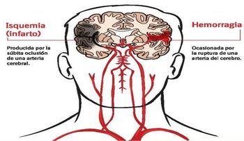 Accidente cerebrovascular tercera causa mortalidad en Venezuela