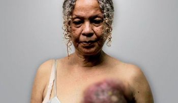 Venezuela está conmovida con el cáncer de seno de Elizabeth Salazar