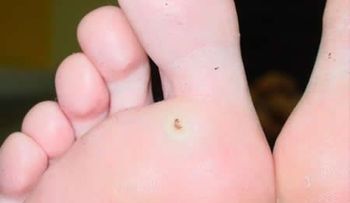 ¿Cómo deshacernos de los molestos callos?