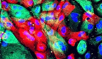 Los casos de cáncer podrían casi duplicarse en 20 años