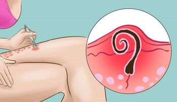 6 excelentes métodos para eliminar los vellos encarnados.