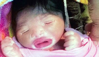 Nace la niña de plástico, un bebé con un rarísimo síndrome y cuya vida está en peligro