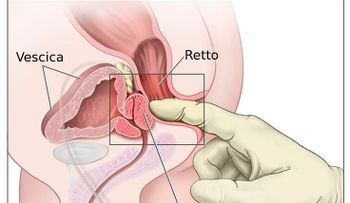 El abuso de las grasas aumenta posibilidad de un cáncer de próstata