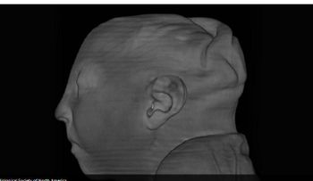 Los científicos ven por primera vez un cerebro de bebé atrofiado por el virus del Zika