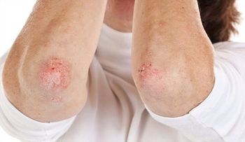 Mexicano crea un jabón artesanal que combate la psoriasis