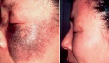 Frotalo en tu piel y en solo 72 horas será suficiente para hacer desaparecer las manches, pecas y arrugas