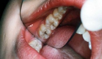 Esto elimina las caries en 20 minutos y un odontólogo nunca de lo dirá 