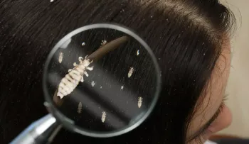 Los piojos del cuerpo humano son causante de la peste