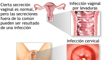 Causas y remedios para el flujo vaginal blanco - leucorrea
