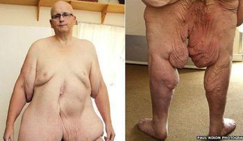 El ex hombre más gordo del mundo que se quitó 25 kilos de piel para caminar mejor