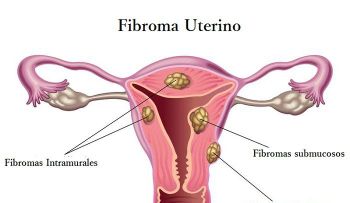 Advierten sobre tratamiento de fibroma uterino 